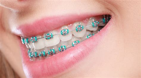 Orthodontic Brackets 